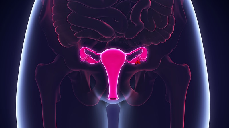 "Huge breakthrough" in advanced ovarian cancer